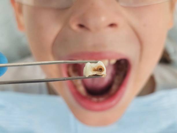 Best Emergency Tooth Extraction  in Scarsdale, NY